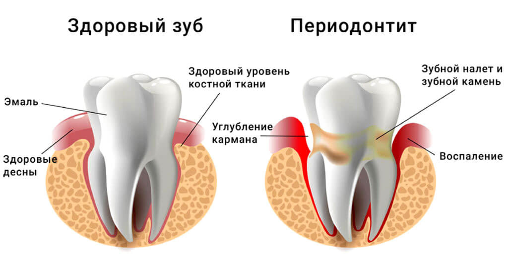 Воспаление корня зуба: симптомы, лечение, профилактика