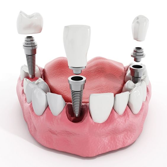 Одномоментная имплантация зубов
