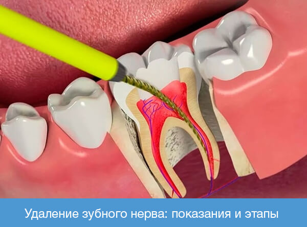 Удаление зубного нерва